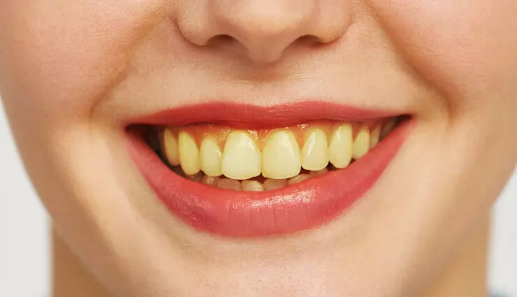 दांतों का पीलापन लगाता हैं पर्सनलिटी में दाग, इन 8 तरीकों से पाएं मोती जैसी चमक