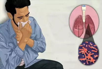 टीबी का निदान लगातार खांसी से परे होना चाहिए- लैंसेट अध्ययन