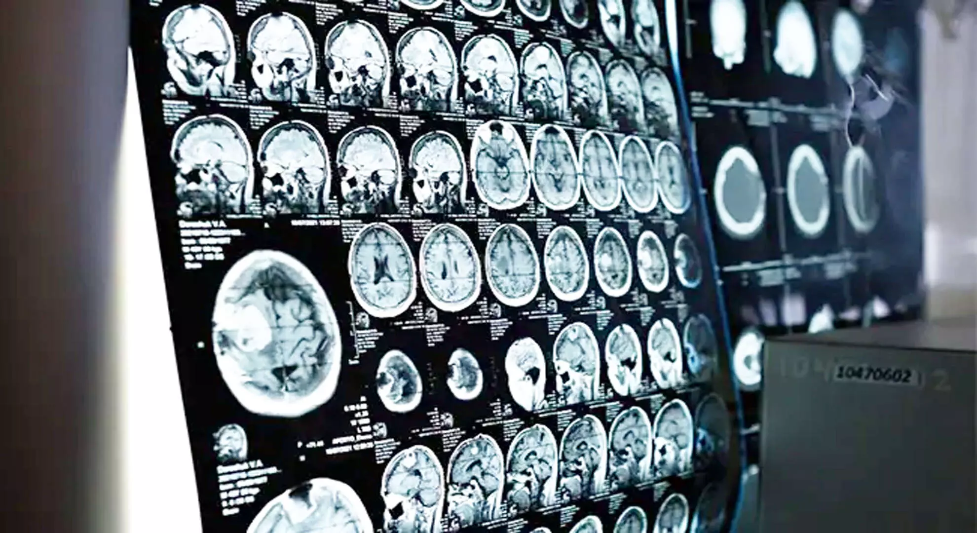 मानव मस्तिष्क बड़ा हो रहा है, और यह कुछ लोगों के लिए अच्छी खबर है: अध्ययन
