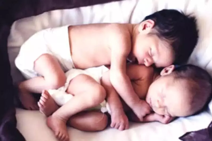 24 सप्ताह में जन्मे जुड़वां बच्चों को जीवित रहने के लिए हर्निया, हृदय दोष का  करना पड़ा सामना