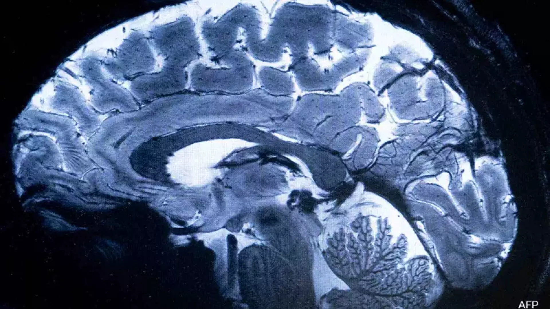 दुनिया की सबसे शक्तिशाली MRI ने मानव मस्तिष्क की पहली छवि स्कैन की