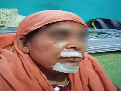 रायपुर शहर की सड़क में जगह-जगह गड्ढे ही गड्ढे, महिला घायल