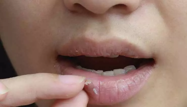 आपके होठों की परतदार त्वचा से छुटकारा पाने के 5 घरेलू उपाय