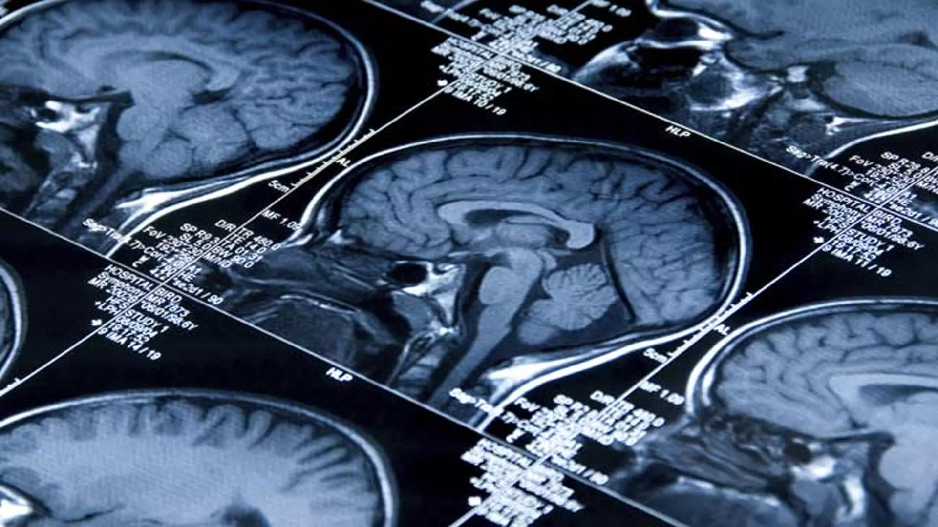 शोधकर्ताओं ने ध्यान के नियंत्रण में शामिल मस्तिष्क क्षेत्र की खोज की