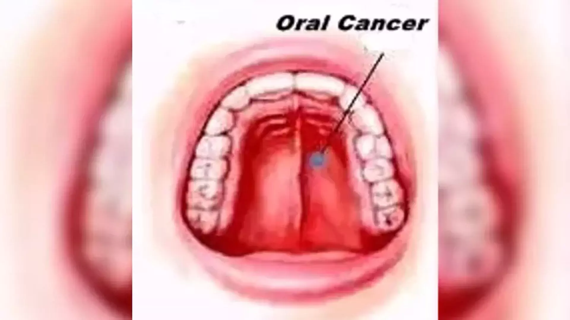भारत में मुंह के कैंसर के मामलों में क्यों देखी जा रही वृद्धि?