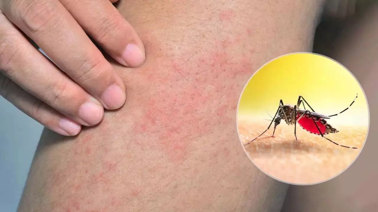 इन सामान्य लक्षणों से करें डेंगू की पहचान