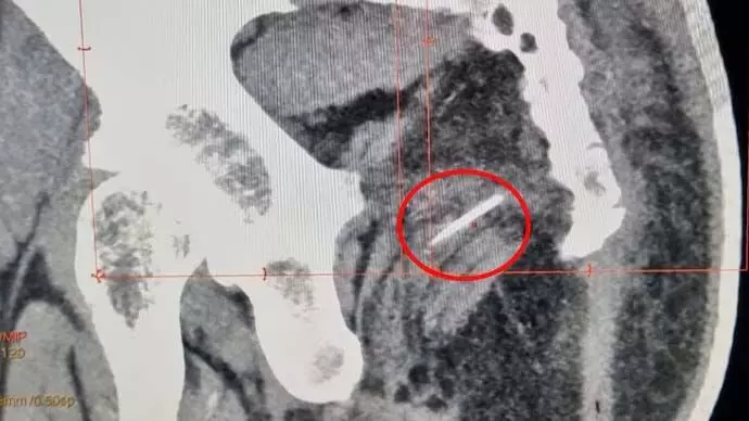 सर गंगा राम अस्पताल के सर्जनों ने महिला के नितंब में फंसी सुई निकाली
