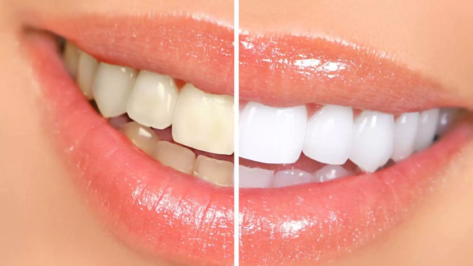 दांतों का पीलापन दूर करें इन 8 उपायों से