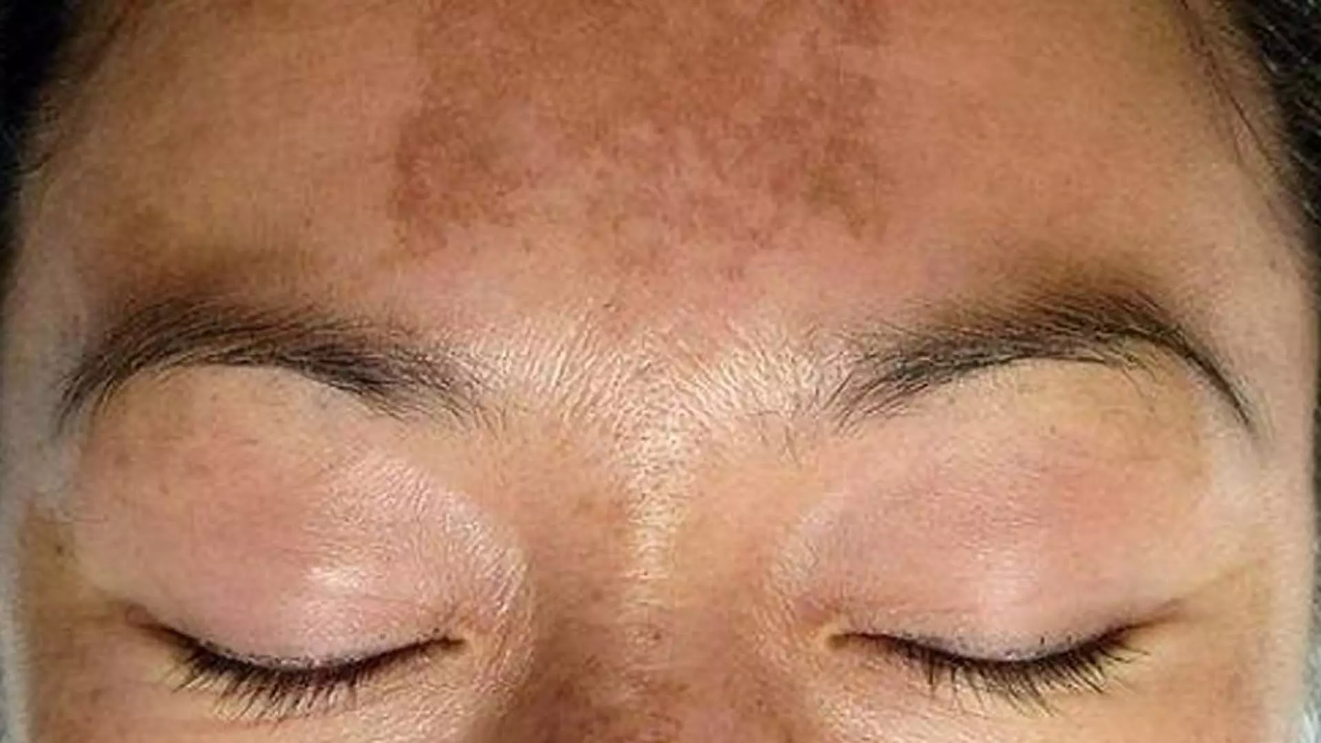 LIFE STYLE: चेहरे पर सनबर्न का इलाज करने के DIY तरीके