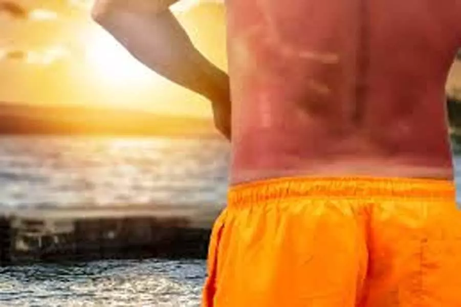 Sunburn : सनबर्न से हो सकती है लिवर किडनी डैमेज, जानें इसके लक्षण और उपचार