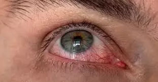 गर्मी के सीजन में बढ़ रहे हैं, Dry Eye Syndrome के केसेज, जाने कैसे करे उपचार ?