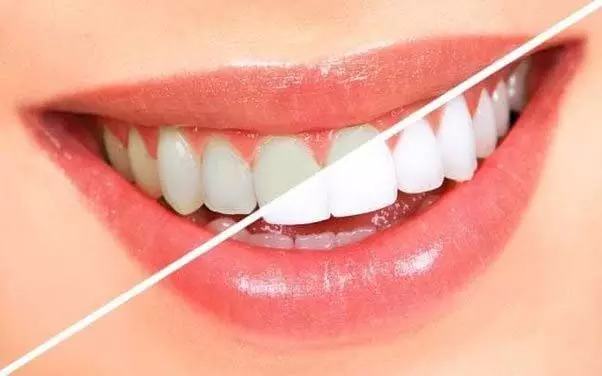 Yellowing of teeth: दांतों का पीलापन दूर करें इस उपायों से