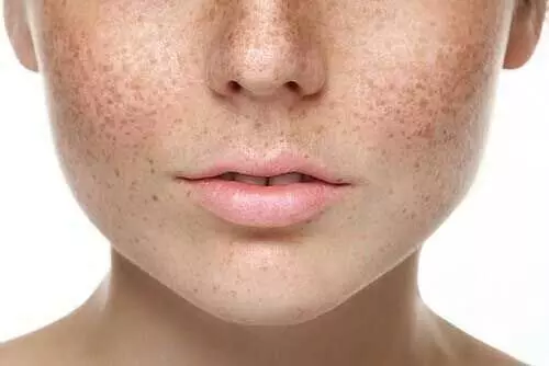 Skin care: कैसे चेहरे की झाइयों से छुटकारा पाए