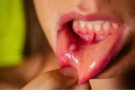 Mouth Ulcers: मुंह के छालों से छुटकारा पाने के लिए घर पर ये चीज़ लगाए