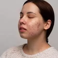 Remedies for removing pimple scars:अब हटाइये घर में ही पिम्पल और एक्ने के दाग धब्बे  जानिए इनकी होम रेमेडी