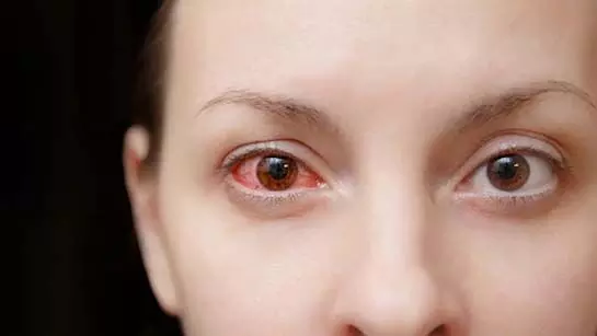Treatment for redness of the eyes: गर्मियों में आंखों की लालिमा का इलाज इन घरेलु उपाय से करें