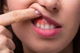 Gum bleeding home remedy: यह नमक मसूड़ों की सूजन और ब्लीडिंग को कम करने में मदद करता है