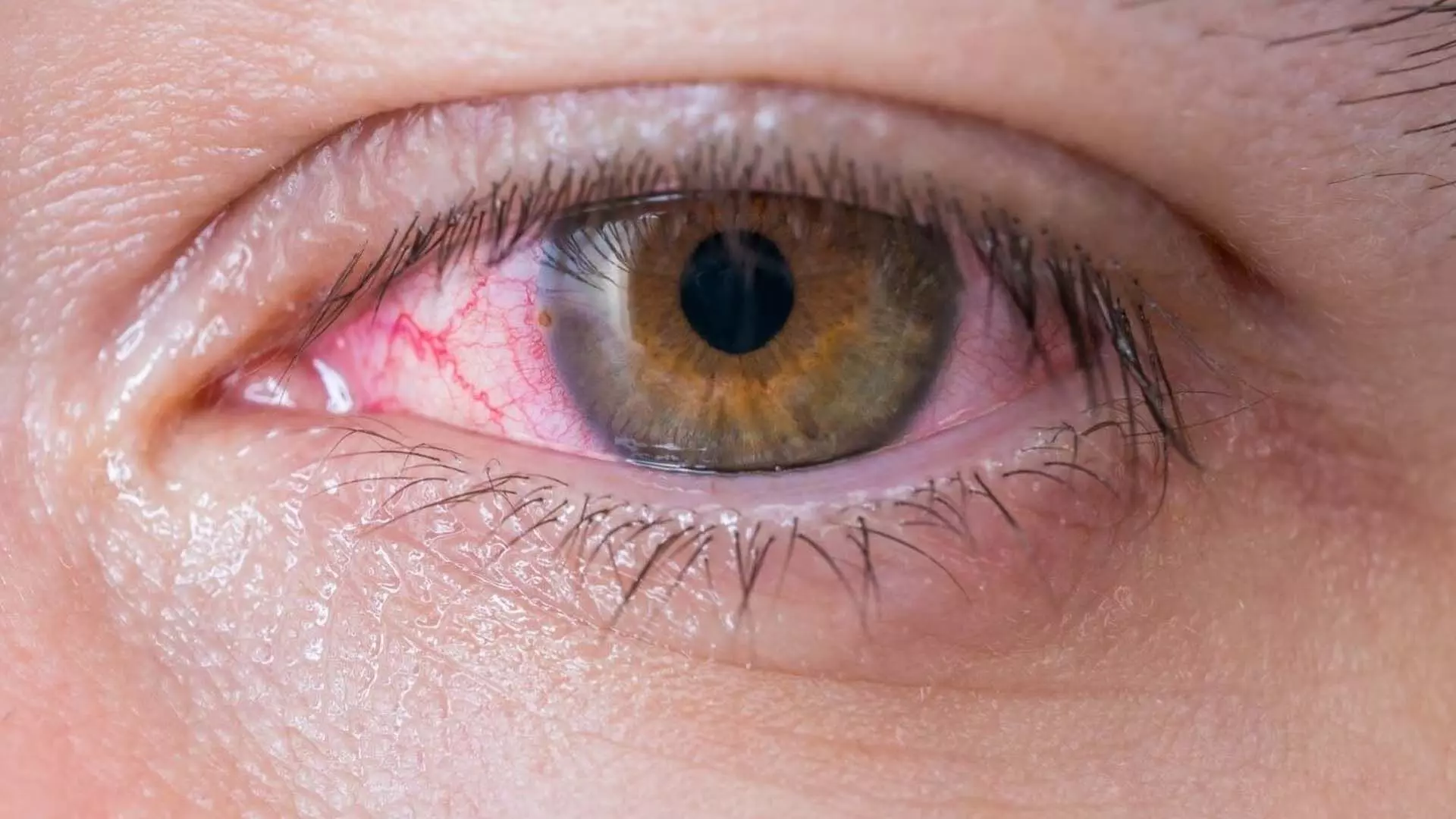 Health:आपको भी होती है आंखों के लाल होने की समस्या आजमाएं ये घरेलू नुस्खें