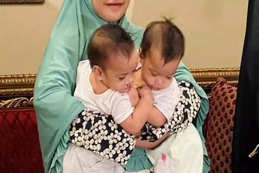 Saudi Arabia ने Filipino जुड़वाँ बच्चों को अलग करने के लिए 7.5 घंटे की सर्जरी शुरू की