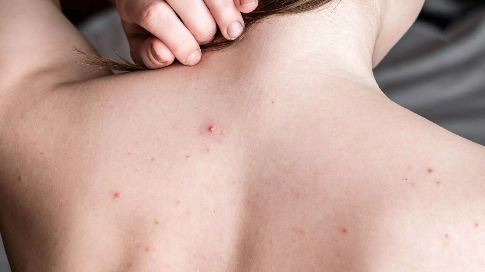 Home remedies for back pimples: गर्मियों में पीठ के मुहांसों के लिए अपनाएं  घरेलु उपाय