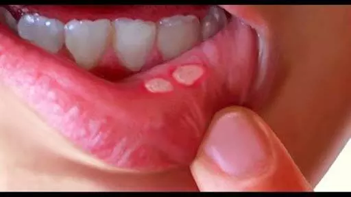 Mouth ulcers: मुंह के छाले से छुटकारा पाने के लिए घरेलू उपाय