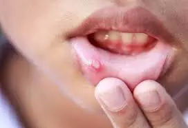 MOUTH ULCER REMEDY : अगर मुँह में होरहे है छाले तोह करिये ये रेमेडी