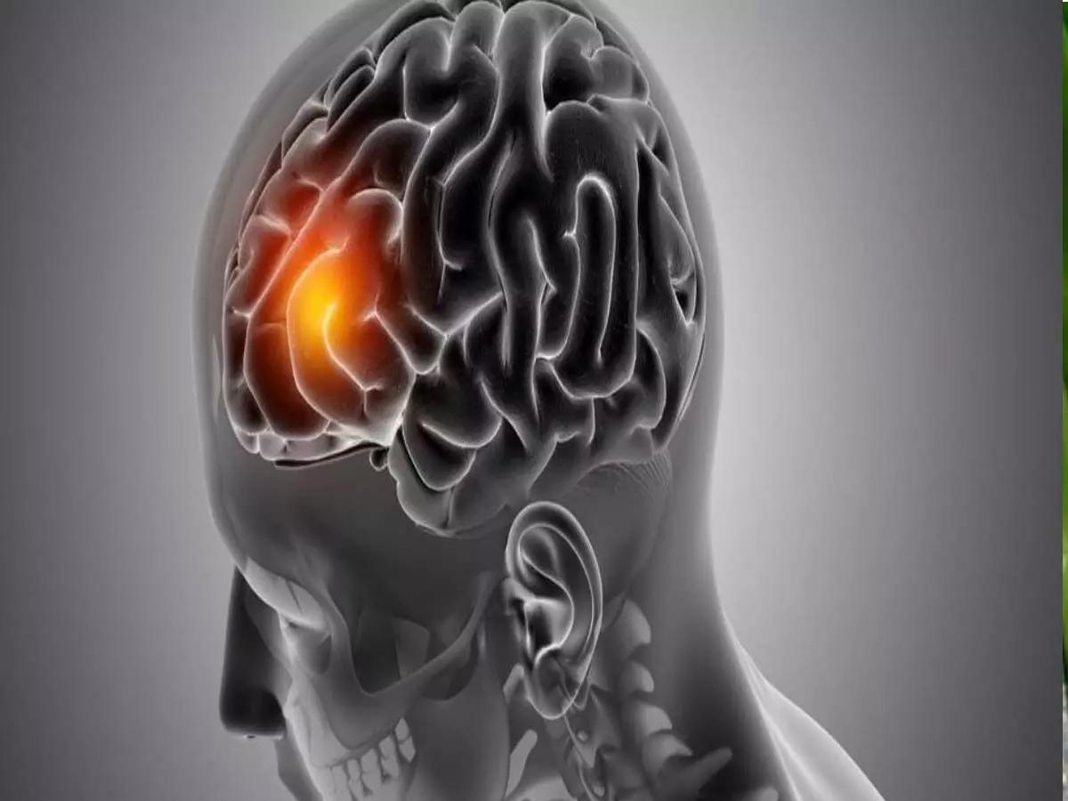 prevent brain tumor; ब्रेन ट्यूमर से बचाने के लिए जानें एक्सपर्ट से लक्षण