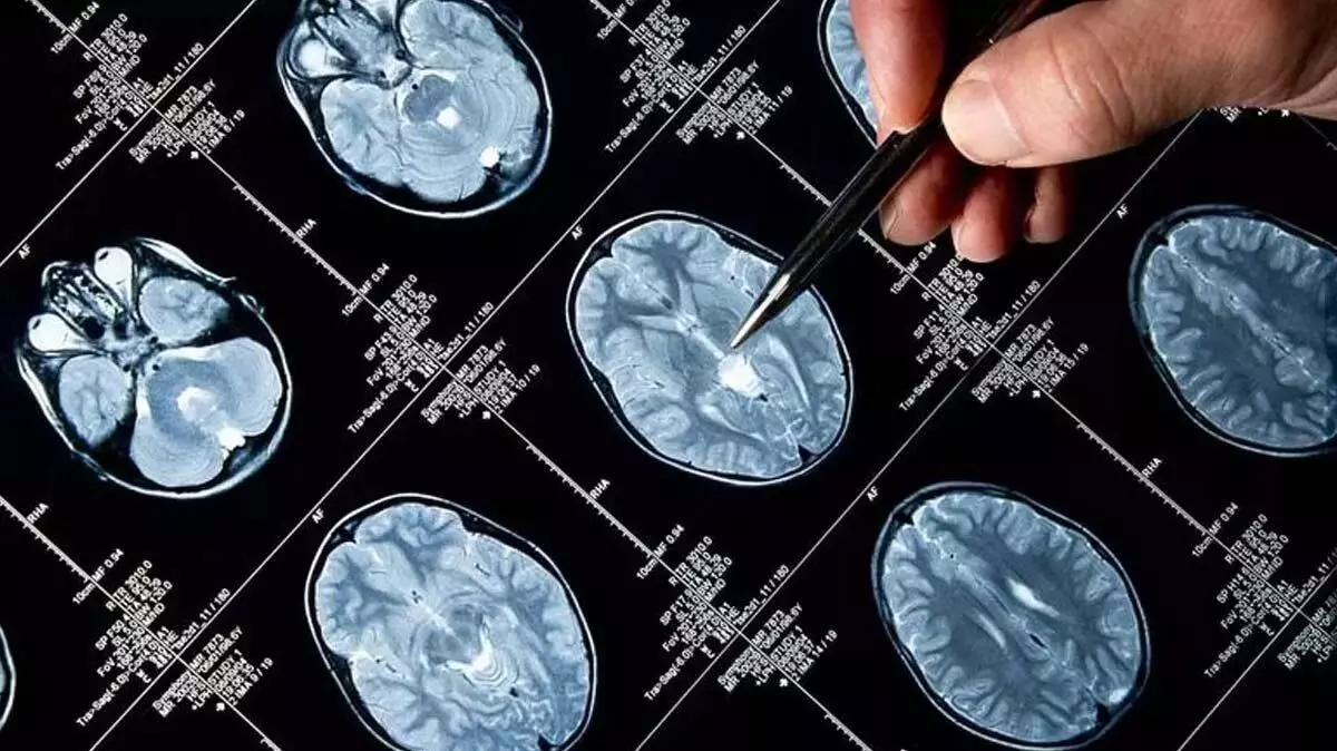 Brain tumor cases; विश्व स्तर पर ब्रेन ट्यूमर के मामलों में हुई वृद्धि