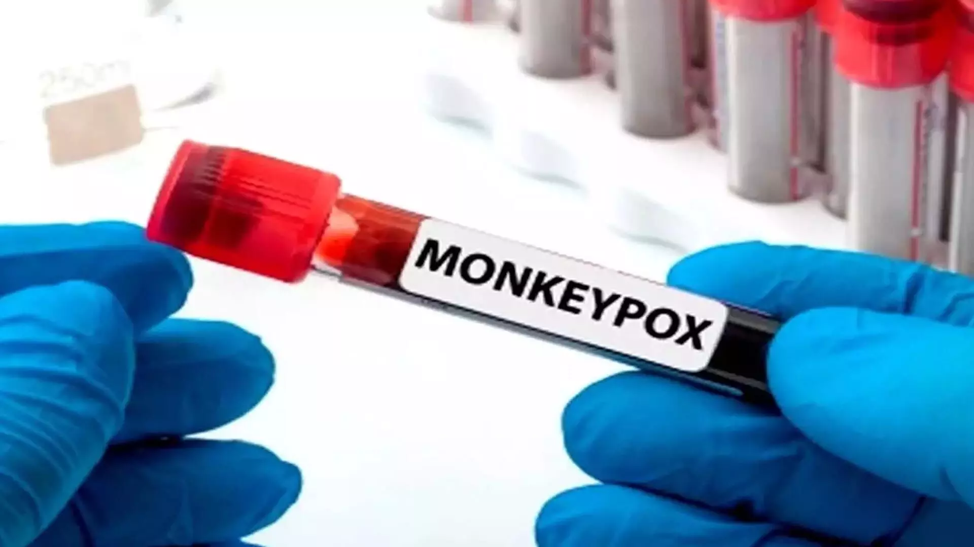 monkeypox: के पांच मामलों की पुष्टि के बाद दक्षिण अफ्रीका में हाई अलर्ट