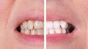 Naturally white teeth: जानिए 1 दिन में प्राकृतिक रूप से सफेद दांत कैसे लाये