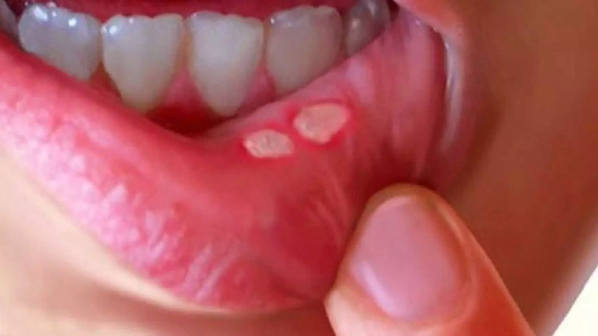 ulcer problem: मुंह के छालों की समस्या इन 10 उपायों से मिलेगा आराम