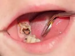 Toothache : अब घर पर ही दांत के दर्द से कीड़े से छुटकारा पाए