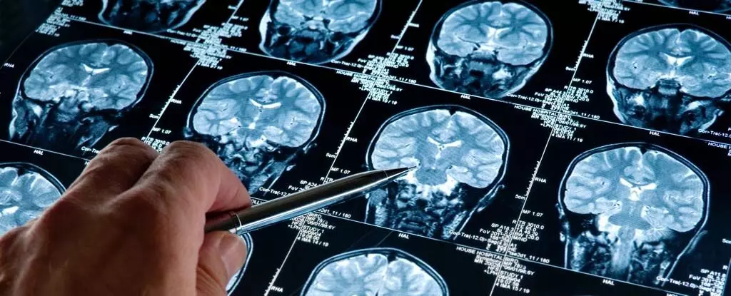 Health| डिमेंशिया विशेषज्ञ ने बताया कि अल्जाइमर के लक्षण वाले कुछ मस्तिष्कों में कोई लक्षण क्यों नहीं होते