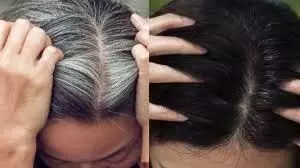 White hair problem: बालों को समय से पहले सफेद होने से रोके जानिए इसके लिए क्या खाना चाहिए