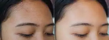 Forehead Tanning: माथे पर टैनिंग नहीं चाहिए तो ध्यान दे ये 3 बातो का, नहीं होगी कभी भीं टैनिंग