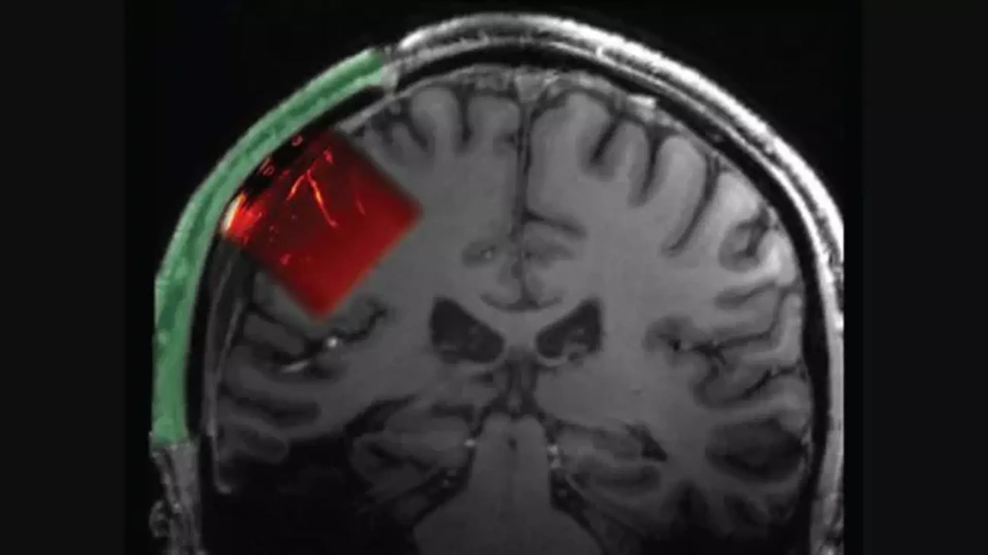 Ultrasound के माध्यम से मस्तिष्क को पढ़ने के लिए शख्स  की खोपड़ी में डाली खिड़की
