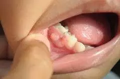 Gum Boils Remedies: आपके भी मसूड़े में हो गया है फोड़ा तो घर पर हे करे ये चीज़े