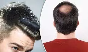 Hair care : गंजेपन की समस्या हैं तो ये जानिए ये आयुर्वेदिक उपाय