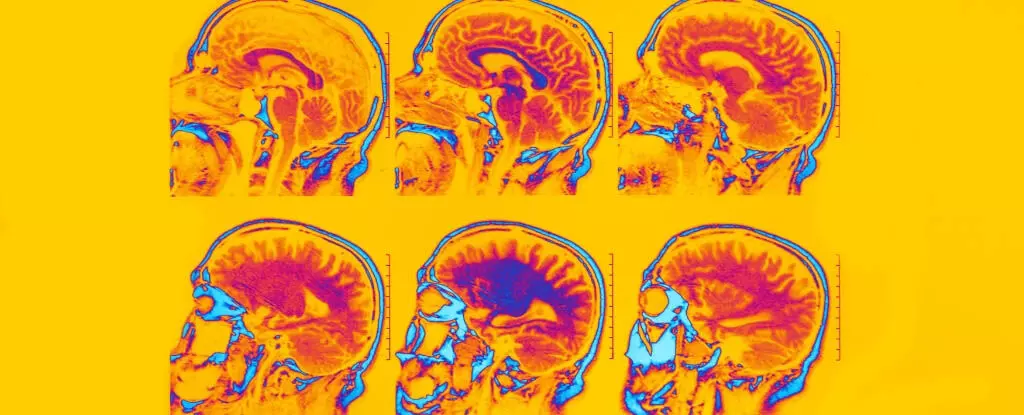 Science: मस्तिष्क स्कैन से अवसाद और चिंता के छह अलग-अलग प्रकारों की पहचान हुई