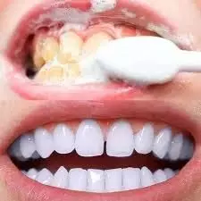 White Teeth in 1 day: एक दिन के अंदर करें पीले दांतों को सफेद