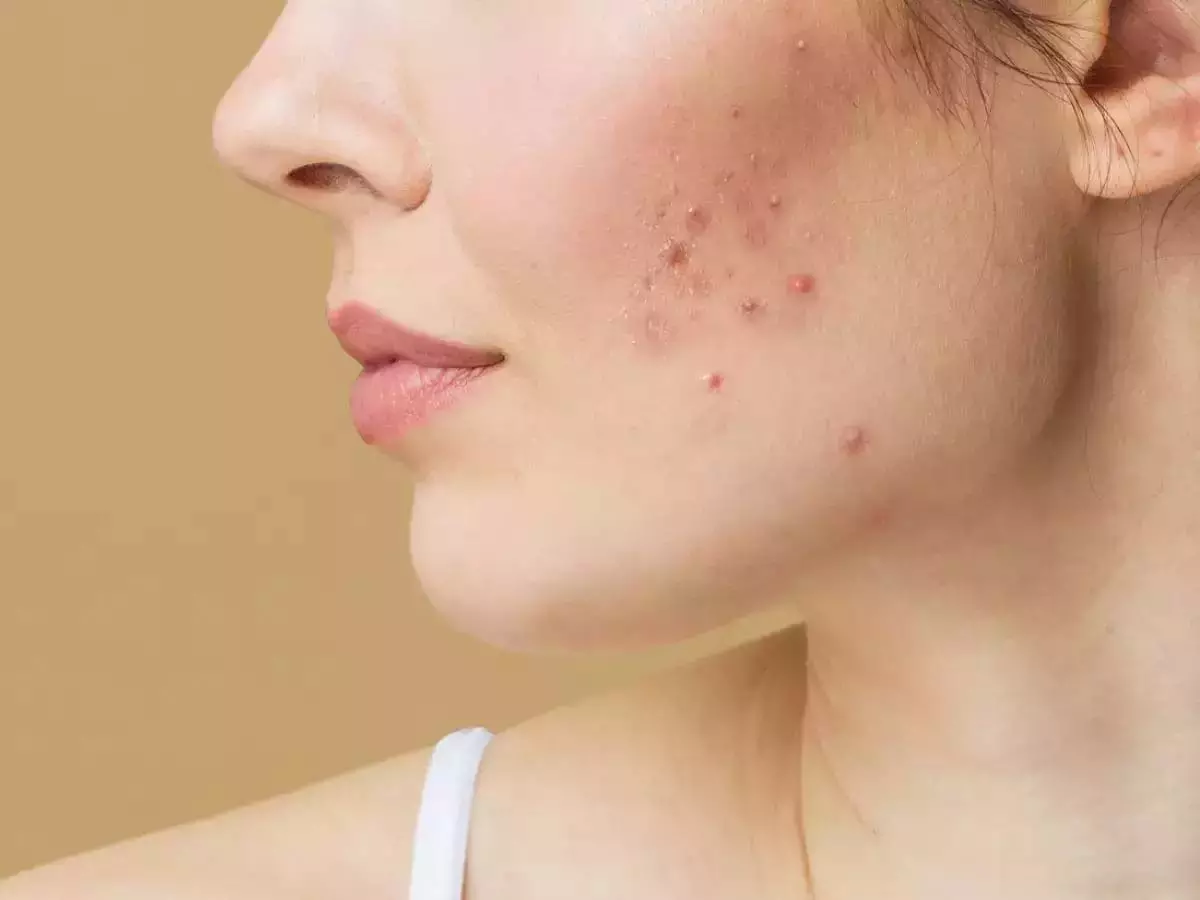 Pimples: गर्मियों में आपकी ये गलतियां बन सकती हैं दाने-फुंसी का कारण