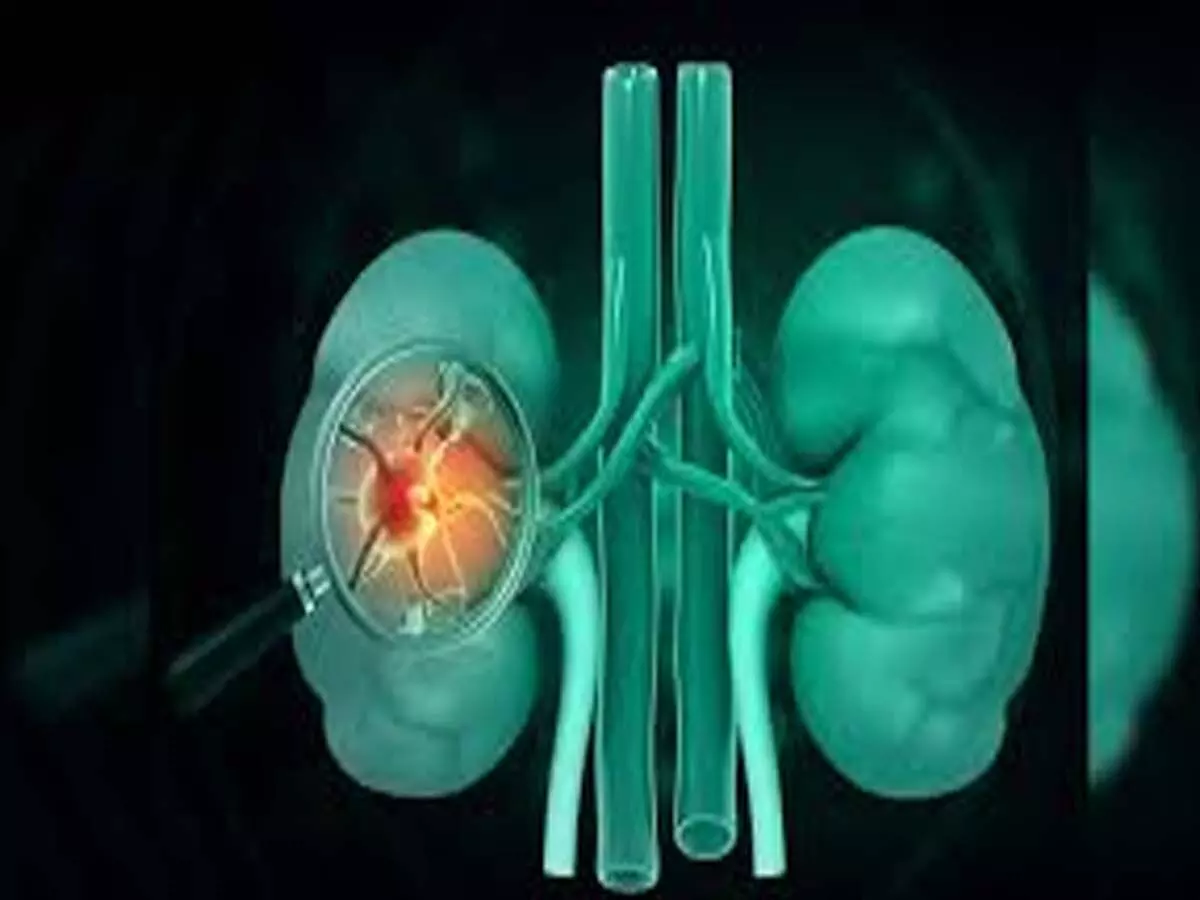 kidney damage : गुर्दे की क्षति का कारण बढ़ सकता है गंभीर मामलें