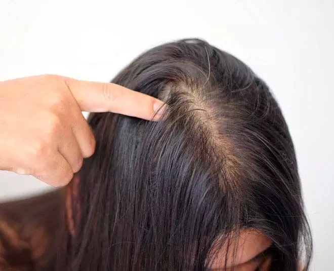 पतले बाल हो जाएंगे घने और लंबे, अपनाये ये hair growth remedy