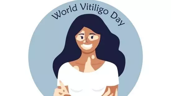 World Vitiligo Day : 25 जून को ही क्यो मनाया जाता है विटिलिगो दिवस