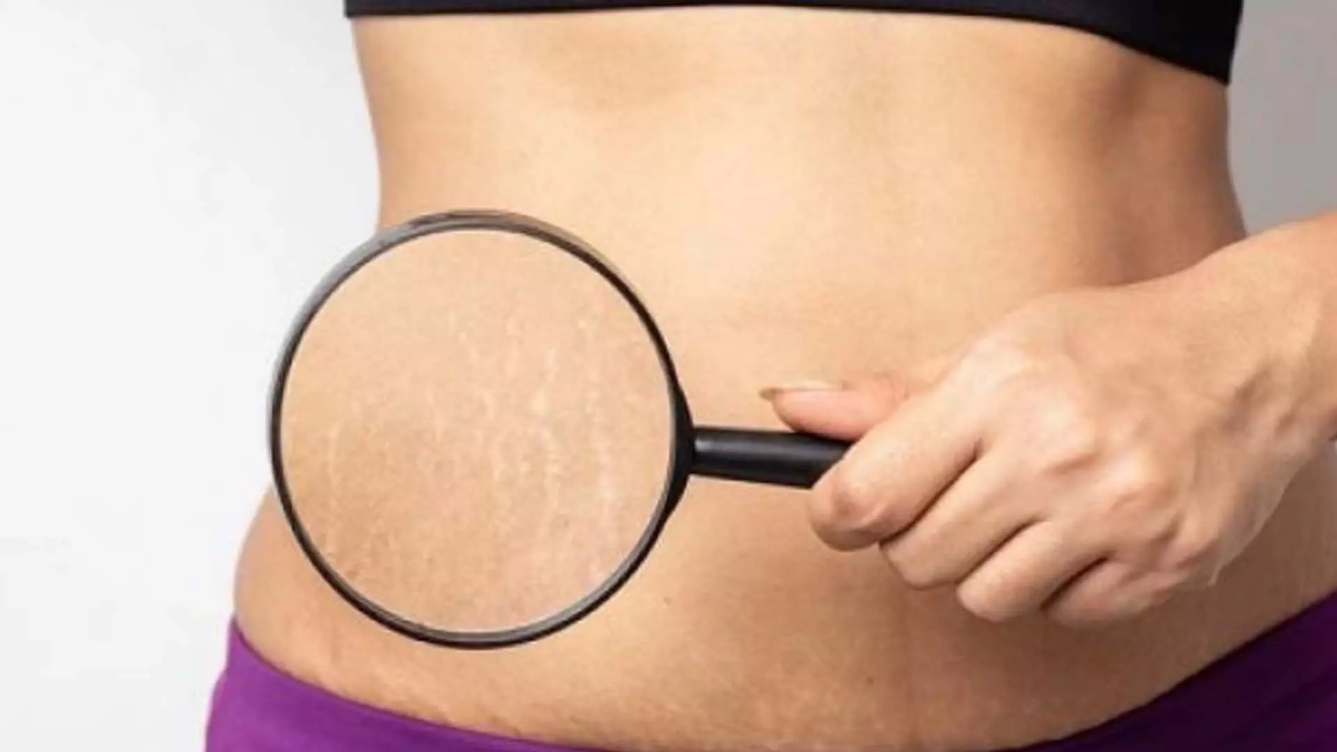 Stretch marks: शरीर में बनते हैं स्ट्रेच मार्क्स इन नुस्खों की मदद से करें इन्हें दूर