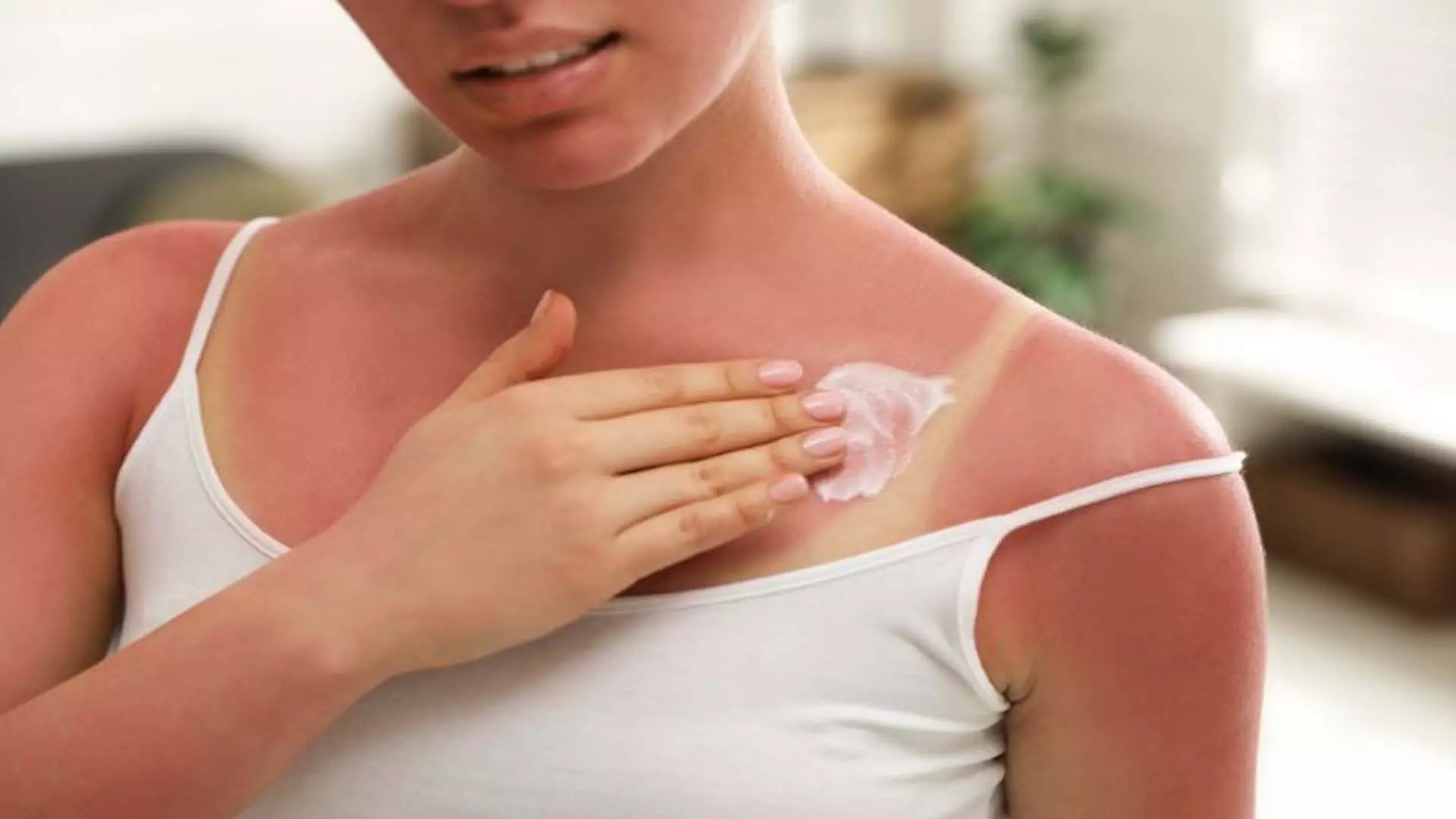 Sunburn: गर्मियों में आम हैं सनबर्न की समस्या आजमाए ये नुस्खें