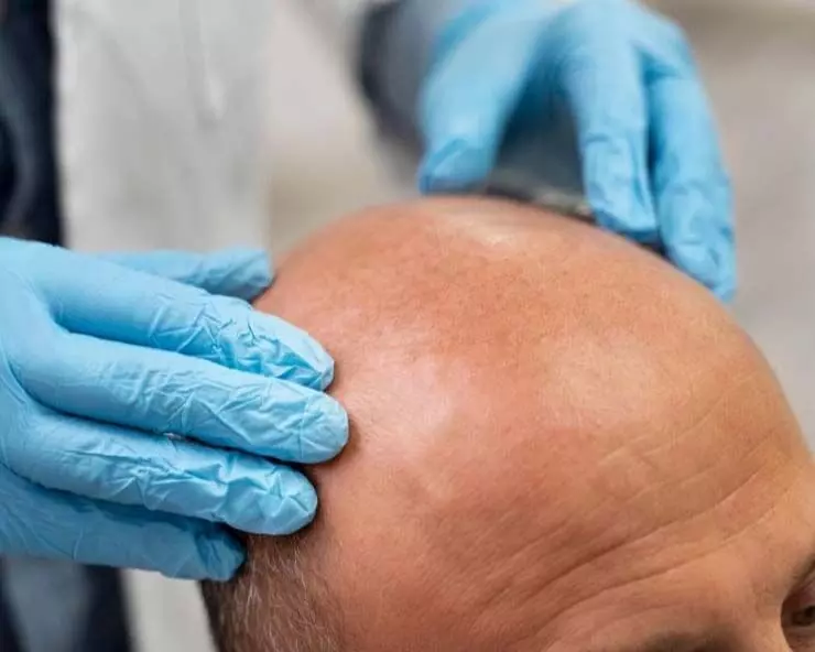 Hair transplant करवाने से पहले जान लें ये बातें