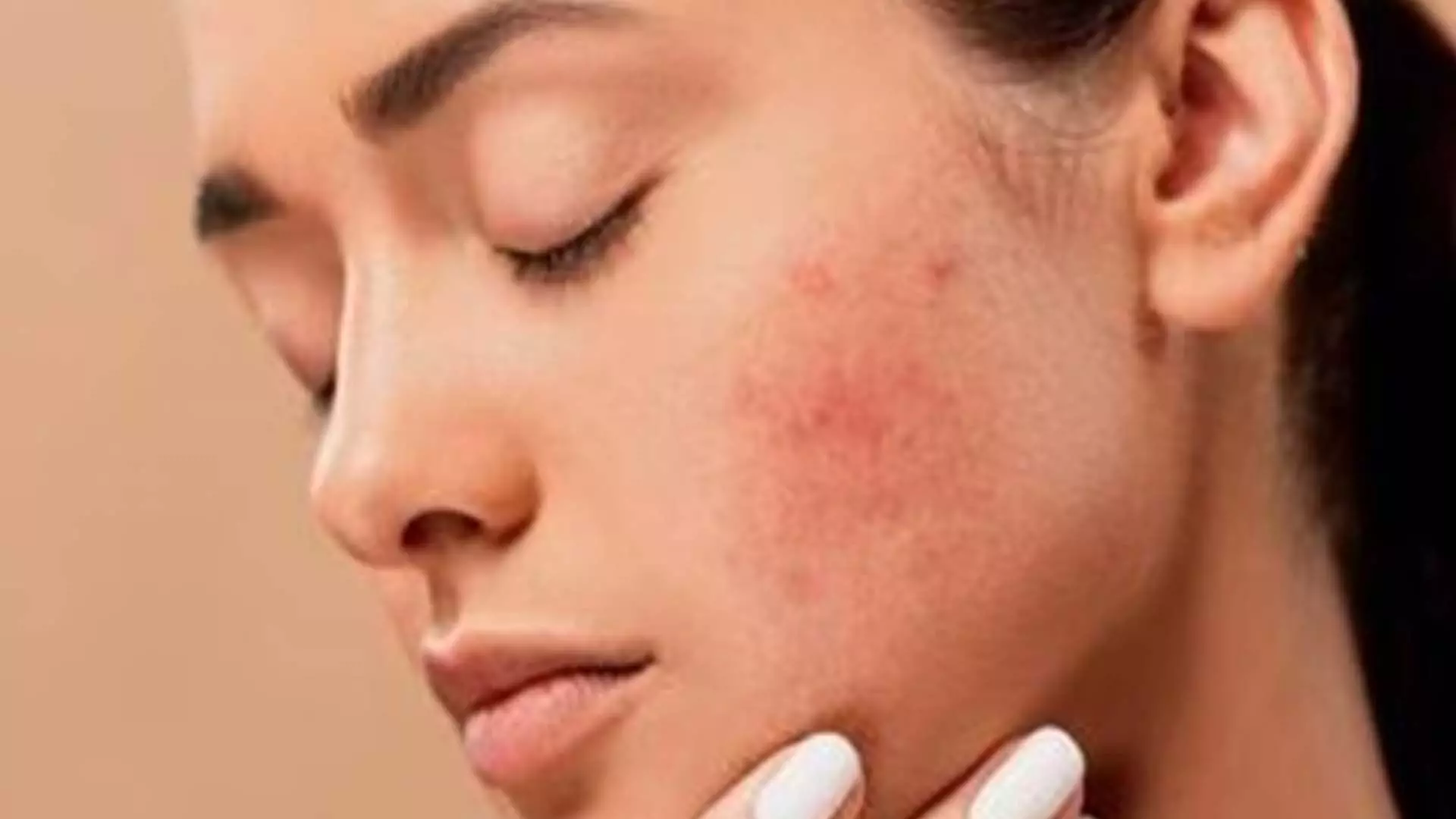 Pimples: पिम्पल्स खराब कर रहे आपके चहरे का लुक इन 10 तरीकों से करें इन्हें त्वचा से दूर