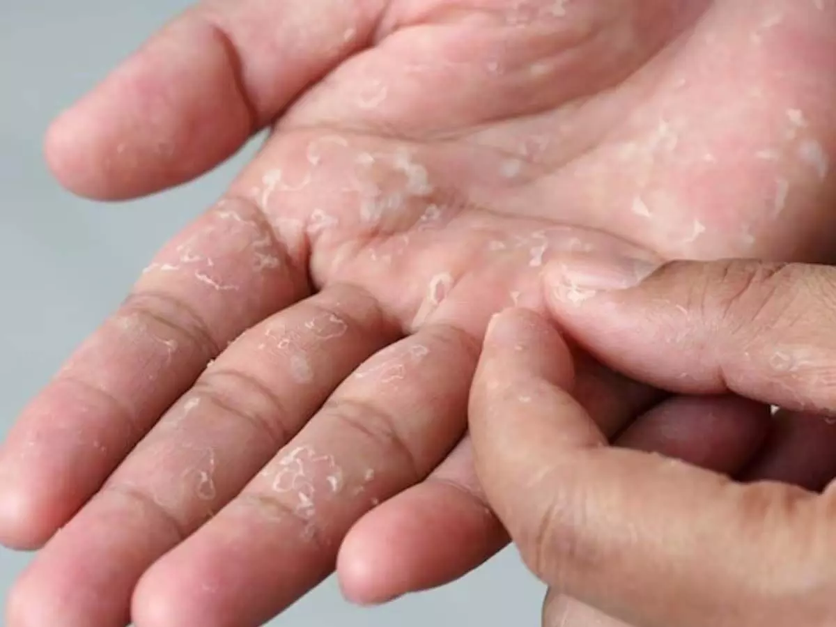 Skin Care: हाथ और पैर की निकलने लगती हैं स्किन जानें  उपाय