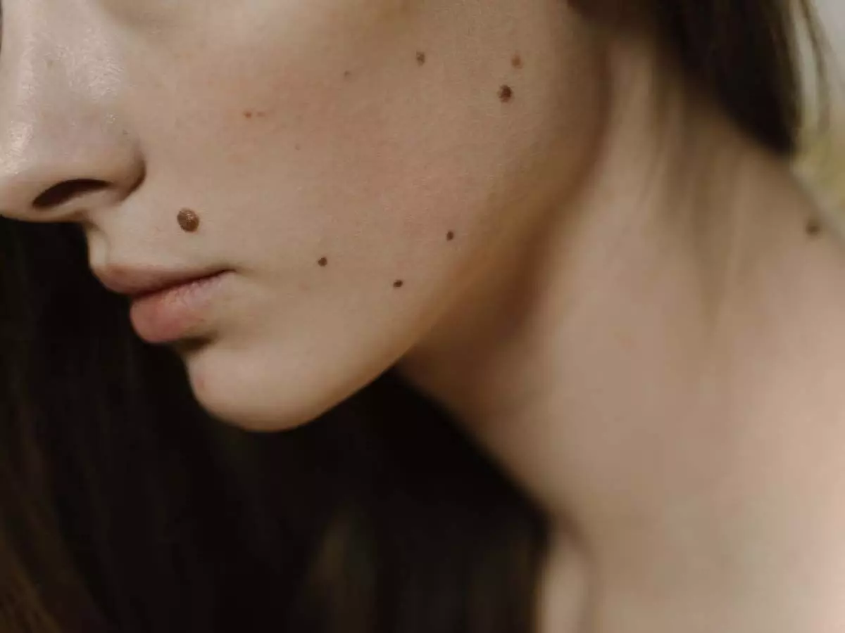 Moles on face: चहेरे पर से तिल हटाने के 7 आसान उपाए